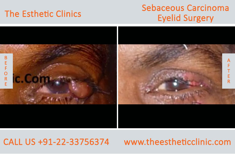 Squamous Cell Carcinoma Treatment, Eyelid Surgery before after photos in mumbai india (1)